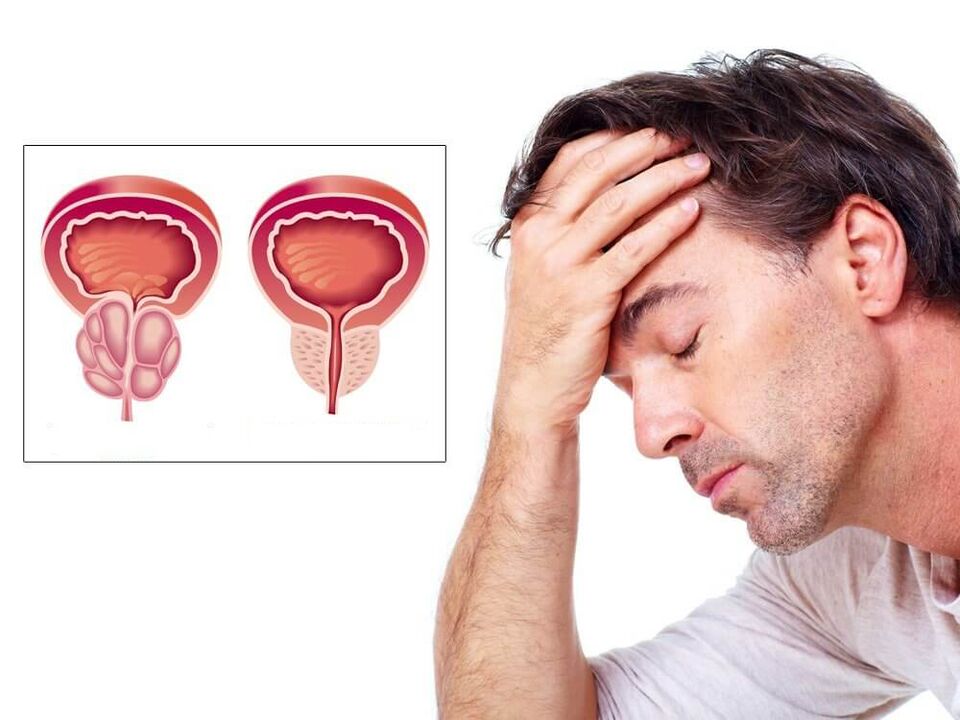 Symptoms of prostate inflammation in men