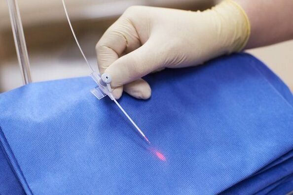 In some cases, laser therapy is used for chronic prostatitis