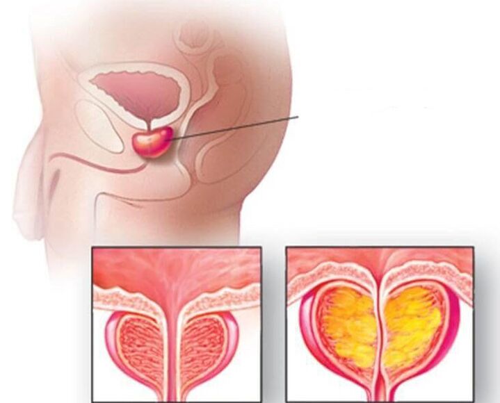 Location of the prostate, normal prostate and enlarged in chronic prostatitis