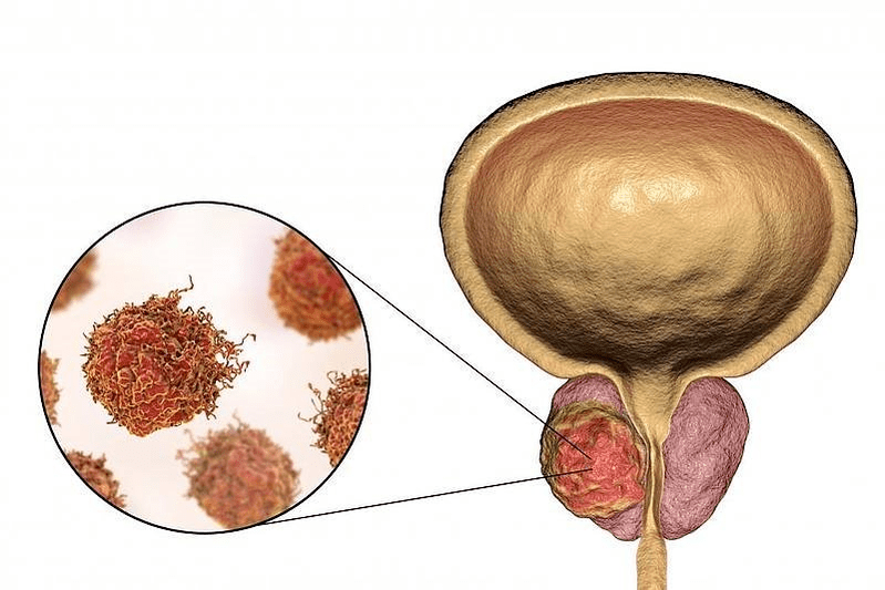 What does prostate damage look like