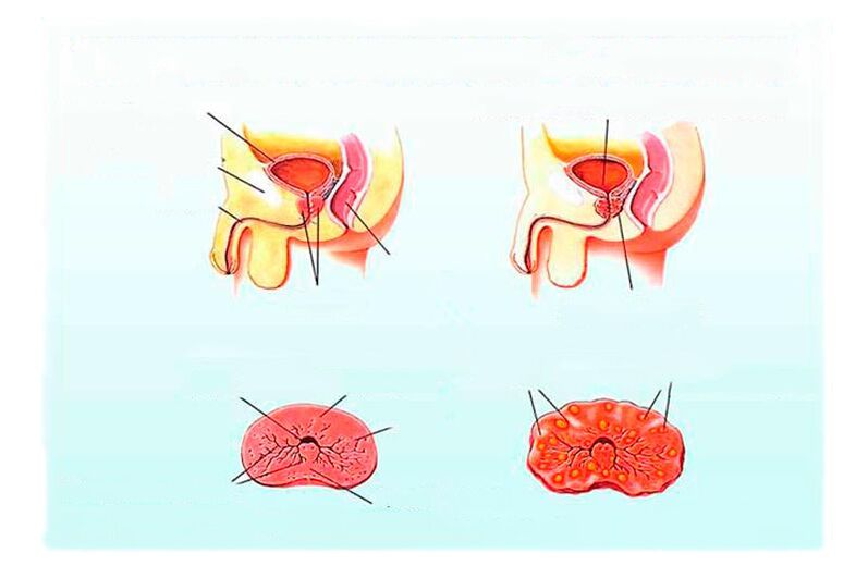Signs of chronic prostatitis