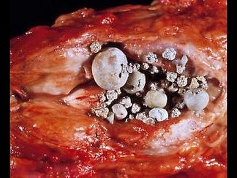 Calcareous prostatitis
